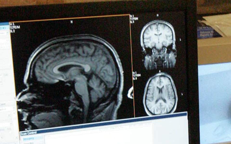 brain-schizo